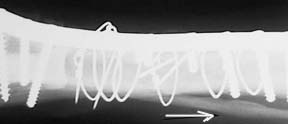 Post op radiograph showing healed fibula