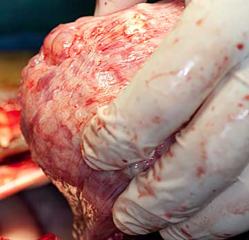 The bladder in the surgeon's hand as he pulls it out of the cavity