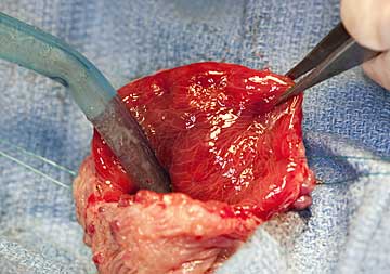 Red and inflamed inner lining of the bladder