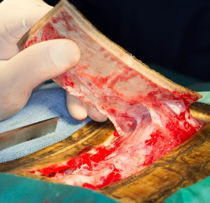 Shell piece being completely removed by our surgeon