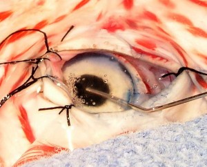 Removing the cataract with a special instrument