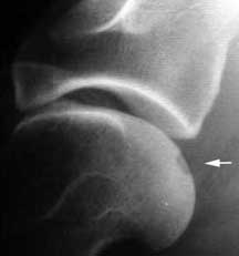 Xray Showing a Piece of Cartilage Missing