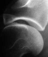 Normal Shoulder Joint X-ray