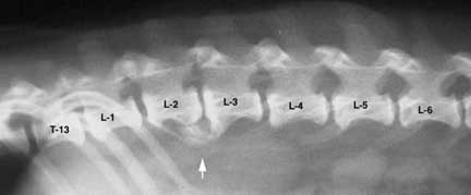 X-Ray of collapsed lumbar vertebrae
