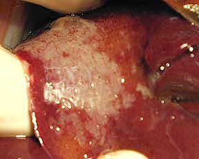 Liver discolored with granulomatous lesions