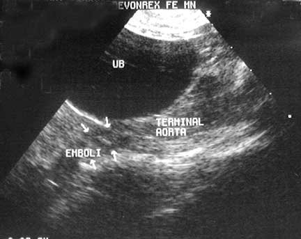 Echocardiogram showing blood clot in leg