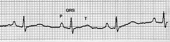 EKG Strip Showing the Electrical Waves