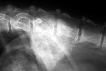 X-ray of bone cancer in the vertebrae