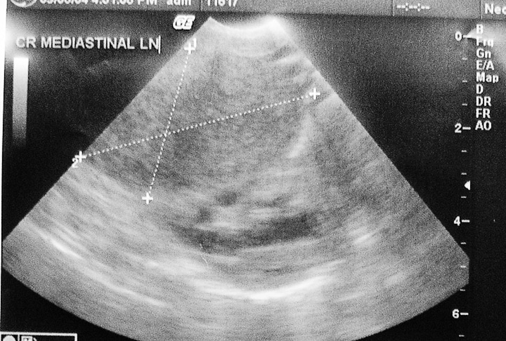 Ultrasound of large lymph node in chest