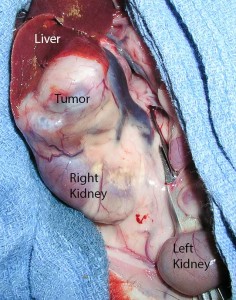 Huge adrenal gland tumor above the kidney
