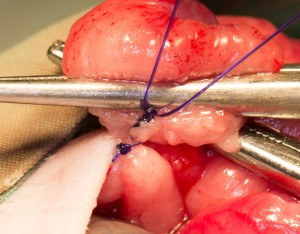 Clamps and suture on blood supply to ovary