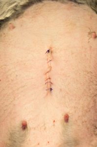 Final skin sutures