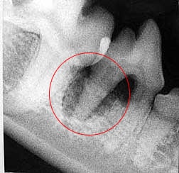 Dental X-ray of Rotten Tooth