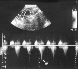 Echocardiogram Picture Of Heart