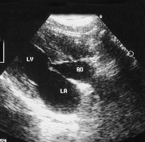 Ultrasound Of The Heart Showing the Aorta And Ventricles