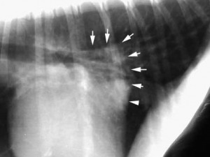 X-Ray Of Enlarged Left Atrium