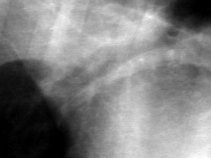 X-ray Close Up Of Artery, Bronchus, And Vein
