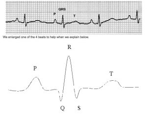 Picture of an EKG Strip