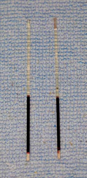 microhematocrit tubes filled with blood.