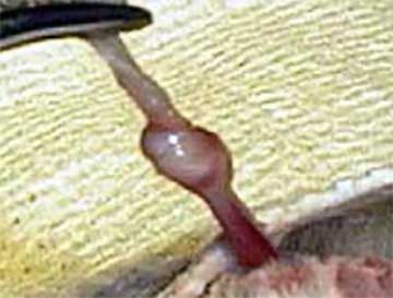 Knot in the spermatic cord