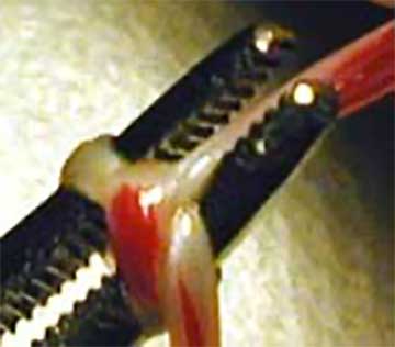 Knotting spermatic cord