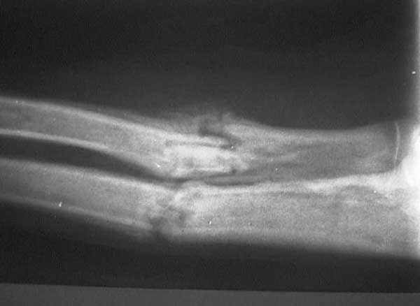 X-ray of healing fracture