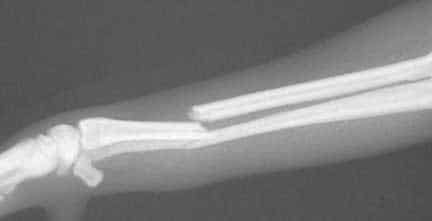 X-Ray of fractured radius and ulna