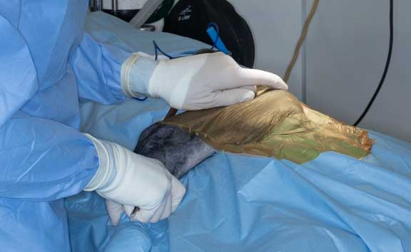 Surgeon pointing to hip in preparing to do removal the femoral head