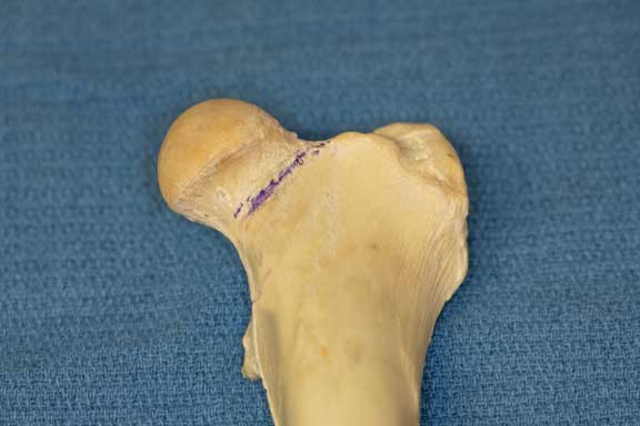 Femur model showing line where fracture occurs.