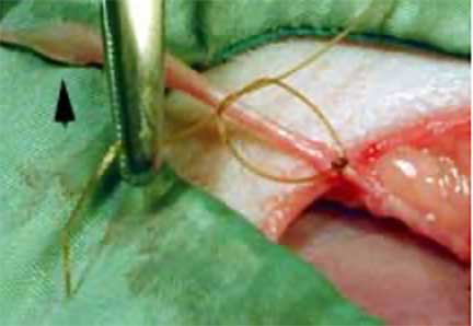 Tying off the spermatic cord with suture