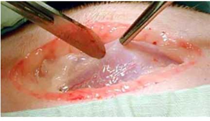 Scalpel incision into abdomen