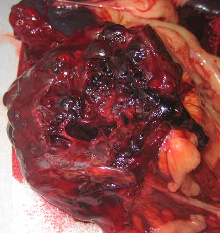 Spleen hematoma opened up