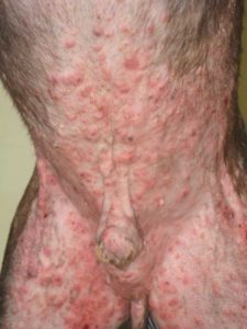 Severe Skin Infection on Abdomen Due To Allergy