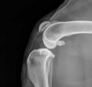 Xray Close Up of a Normal Knee Joint Lateral View