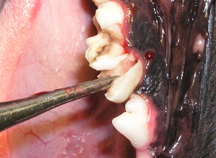 Removing cracked tooth