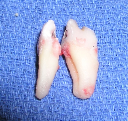 Removed tooth