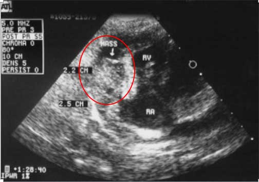 Ultrasound showing tumor in the heart
