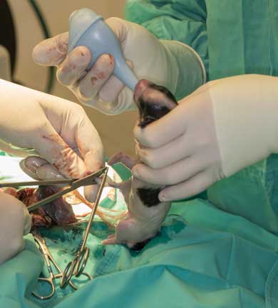 Surgeon clamping umbilicus