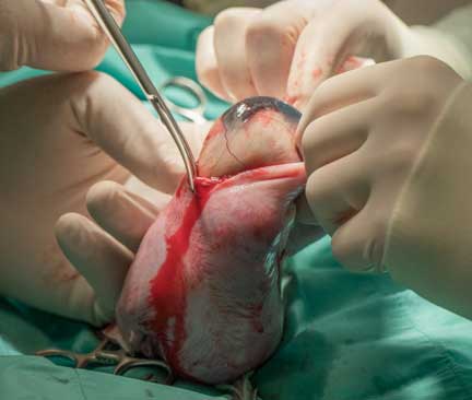 Surgeon cutting uterus