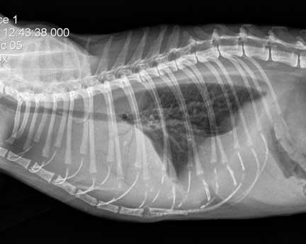 X-ray of pleural effusion