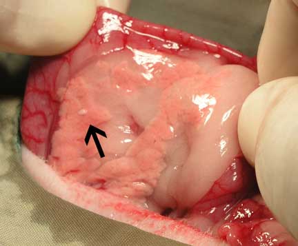 Arrow pointing to an insulinoma nodule in the pancreas.