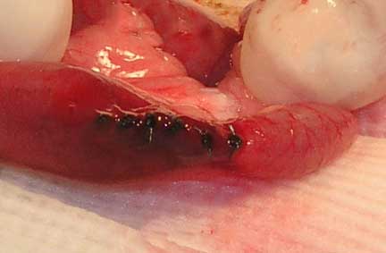 Small intestines sutured after removal of a foreign body.