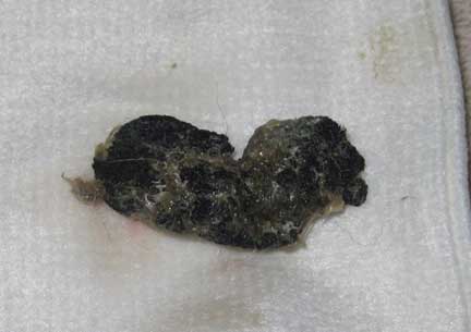 Plastic foreign body removed from small intestine.