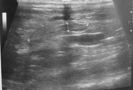 Ultrasound of a ferret intestinal foreign body.