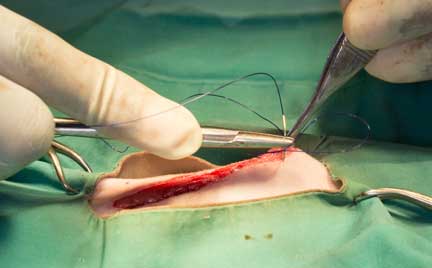 Suturing the abdominal muscles.