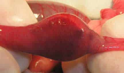 Foreign body in small intestine.