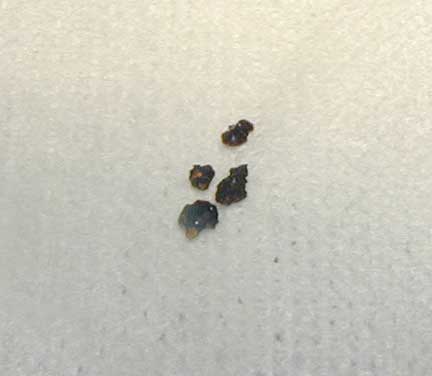 Gall stones after removal