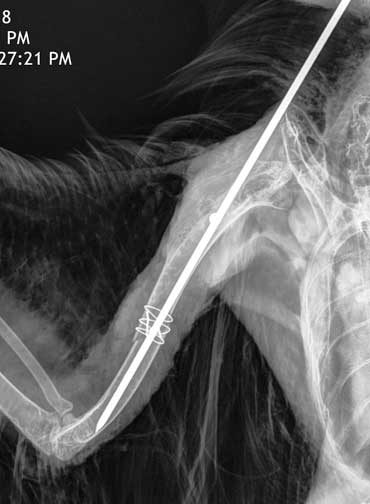 IM pin and cerclage wires in hawk humerus