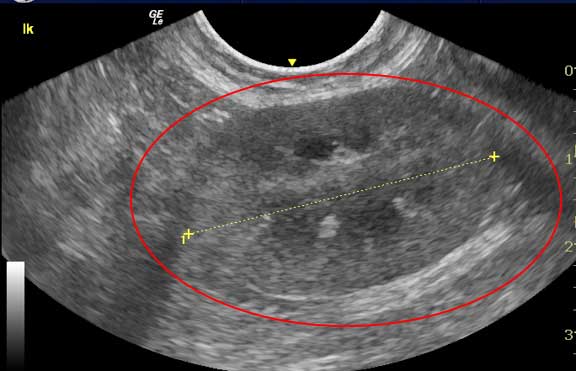 Ultrasound of the kidney