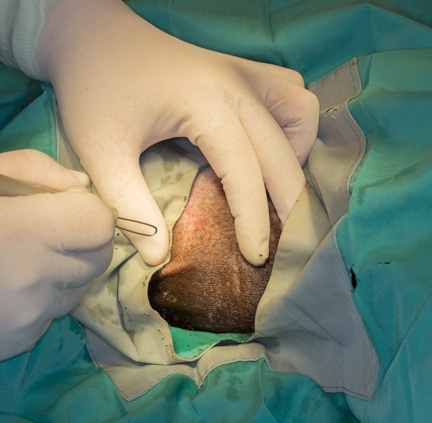 Preparing for laser incision.